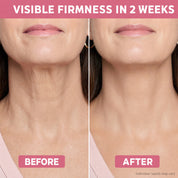 Before and after, visible neck firmness in 2 weeks